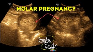 Molar Pregnancy  Hydatidiform Mole  Gestational Trophoblastic Disease  Ultrasound  Case 38 [upl. by Halik]