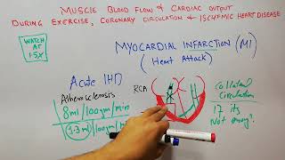 CVS 201  Myocardial infarction  Subendocardial infarction  Heart attack [upl. by Auqinu]