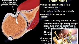 Lesions Of The Shoulder  HillSachs Lesion  Everything You Need To Know  Dr Nabil Ebraheim [upl. by Nylarej]