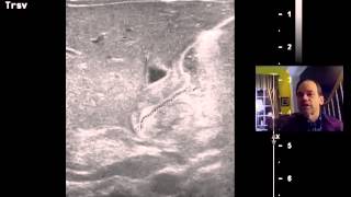 Pyloric Stenosis Ultrasound DISCUSSION 1 [upl. by Shiller]