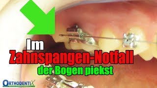 Im ZahnspangenNotfall der Bogen piekst feste Zahnspange Kieferorthopäde  Orthodentix [upl. by Crean]