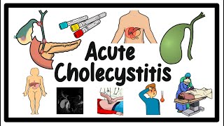 Gallbladder Guide All You Need to Know About Acute Cholecystitis [upl. by Ennairda]