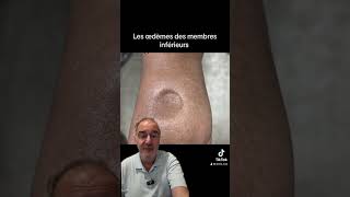 Pourquoi a t on les jambes gonflées [upl. by Sanoy]