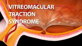 Vitreomacular Traction Syndrome [upl. by Tennos]