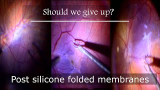 Technique of a safe Peeling of 3 macular membranes after silicone oil PPV [upl. by Acsisnarf]