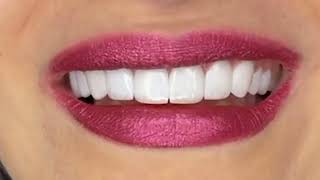 InstaSmile Clip on Teeth Veneers Closeup [upl. by Granville]