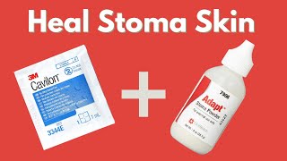 Healing Ostomy Skin Irritations  Crusting Technique quick amp simple  StomaCare [upl. by Nedyaj]