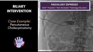 BILIARY INTERVENTION Case Example  PERCUTANEOUS CHOLECYSTOSTOMY [upl. by Wilek]