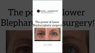 Want to get rid of undereye bags and wrinkles Lower lid blepharoplasty could be the solutioneyes [upl. by Aiam]