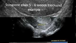 Ultrasound 12 DPO maybe 4 Weeks [upl. by Cnut325]