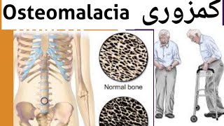 Osteomalacia Causes symptoms Diagnose Treatment  Medicine for Osteomalacia in HindiUrdu [upl. by Beaver]