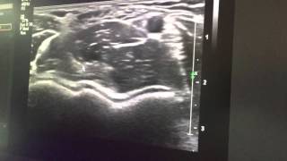 Demo echografie elleboog Biceps Arterie Medianus BAM [upl. by Etnahs526]