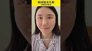 去过韩国的应该都知道 脂肪填充 填充失败 脂肪修复 fyp glowup facialcontouringsurgery rhinoplasty plasticsurgery [upl. by Claud]