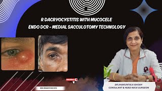 R DACRYOCYSTITIS WITH MUCOCELEENDO DCR  MEDIAL SACCULOTOMY TECHNOLOGY DRSHAKUNTALA GHOSH [upl. by Jillane]