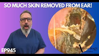 SO MUCH SKIN REMOVED FROM PATIENTS EAR CANAL  EP945 [upl. by Nillad]