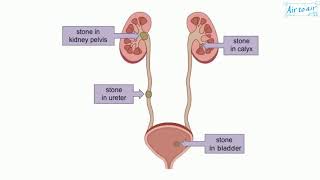 lithiasis [upl. by Fulks]