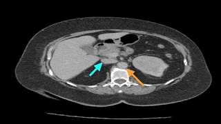 Clinical Case Renal Cell Carcinoma [upl. by Ragland478]