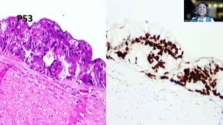 Tip82 Highgrade Appendiceal Mucinous Neoplasm [upl. by Nevil]