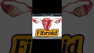 Fibroid Uterus  Degenerative Fibroid  Mass Uterus on Ultrasound [upl. by Launamme]