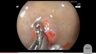 How to take Endoscopic Forceps Biopsy [upl. by Anner]