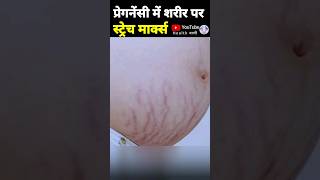 प्रेगनेंसी में स्ट्रेच मार्क्स को कैसे रोकें pregnancystretchmarks striae stretchmark [upl. by Ame]