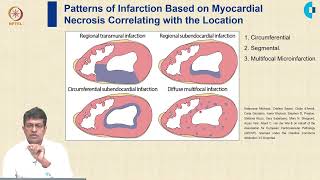 Myocardial Infarction MI Pathophysiology [upl. by Akimat]