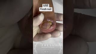 TOENAIL FUNGAL INFECTION nailfungal nailinfection ingrowntoenailsurgery foryou [upl. by Renwick]