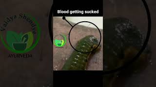 Leech therapy in skin disease in timelapse drpys [upl. by Drescher]