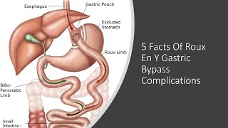 5 Facts Of Roux En Y Gastric Bypass Complications [upl. by Goldshlag]