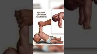 hypotonia baby parenting trending memes youtubeshorts shortsfeed [upl. by Charil724]