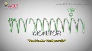 Ventricular Tachycardia by ACLS Certification Institute [upl. by Sharron983]