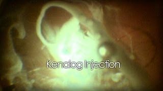 Intravitreal Kenalog Injection [upl. by Ylimme136]