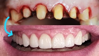 Front Tooth Crowns Before amp After Cosmetic Dentist Smile Makeover EMAX Preparation Remove Veneers [upl. by Monika]