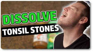 Dissolve Tonsil Stones At Home With Only 3 Ingredients [upl. by Kristan]