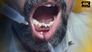 “Is Pulling a Tooth That Easy Dentist Explains in 1 Minute” Subtitled [upl. by Seluj957]