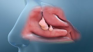 Nasal Polyp Removal Surgery [upl. by Ardnat]