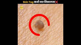 Skin Tag कभी मत निकालना ❌  Never Remove Skin Tag  The Fact  shorts ytshorts [upl. by Aivilys]