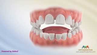 Orthodontic Treatment for Tongue Thrusting Habit  Different Options [upl. by Sadowski]