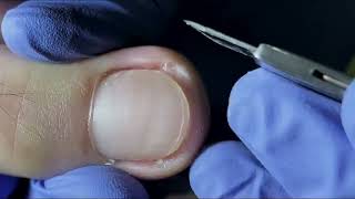 Ingrown Toenail Removal  Pedicure Treatment and Very Satisfying  Best Satisfying Nail Cutting [upl. by Akenaj]