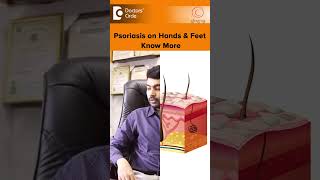 PSORIASIS on Hands amp Feet Palmoplantar Psoriasis TreatmentDrRajdeep MysoreDoctors Circleshorts [upl. by Ellersick]