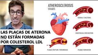 Las PLACAS de aterosclerosis NO están formadas por COLESTEROL LDL [upl. by Lamek427]