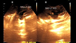 Bilateral hydro nephrosis  Bilateral dilated ureter  Renal Ultrasonography [upl. by Macintyre929]