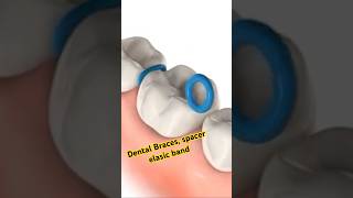 Braces  orthodontics Spacers bands [upl. by Gareth]