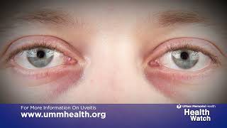 Health Watch Uveitis Causes and Treatment [upl. by Faina614]