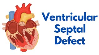 Ventricular Septal Defect Types Pathology Symptoms amp treatment [upl. by Eldwen142]