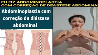 Fiz CORREÇÃO de diástase Com ABDOMINOPLASTIA abdominoplastia [upl. by Rintoul]