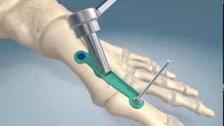 1st metatarsalphalangel joint fusion procedure [upl. by Adnamor]