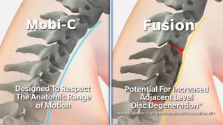 Mobi C vs fusion movement in neck [upl. by Osmo]