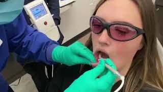 Laser treatment for cold sores and canker sores [upl. by Aiht]