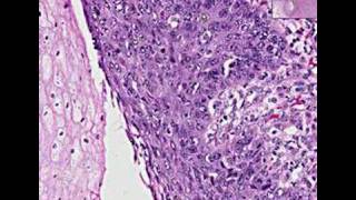 Histopathology EsophagusSquamous cell carcinoma [upl. by Llertnom]